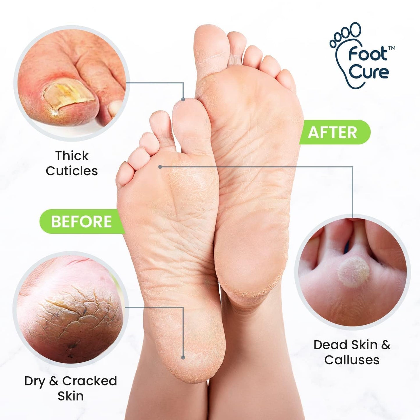 FOOT CURE Exfoliator & Callus Remover Pedicure Set – Care Kit Includes File for Dead Skin, Tea Tree Oil Soak Salts, Urea Cream 40 Percent Removal Gel Made in USA, 4 Piece FOOT CURE buy supplements Au