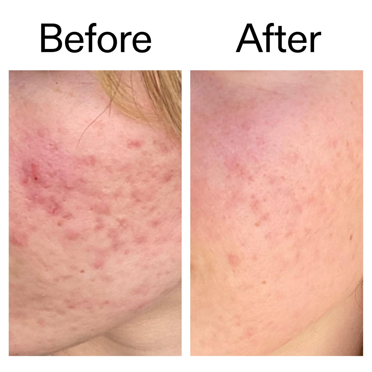 The INKEY List SuperSolutions Azelaic Acid 10% Serum, Fast-Absorbing Formula Helps Reduce Appearance of Redness and Soothes Skin,