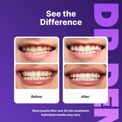 DRDENT Purple Teeth Whitening Strips 21 Treatments - Safe for Enamel - Non Sensitive Teeth Whitening