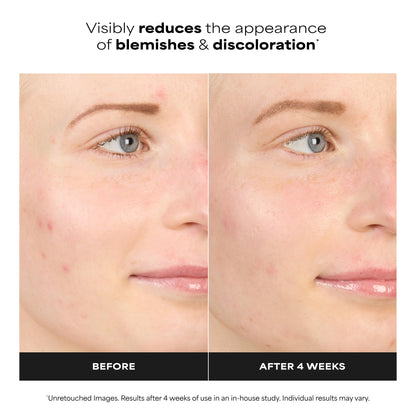 Paula’s Choice BOOST 10% Azelaic Acid Booster Cream Gel, Oil-Free Serum Fades Discoloration & Post-Blemish Marks, with Licorice Extract