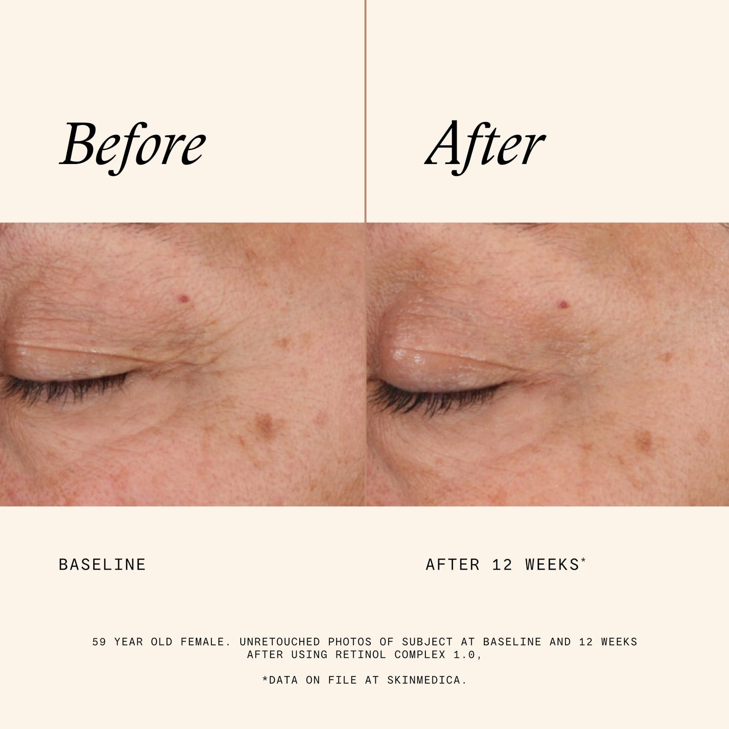 SkinMedica Retinol Serum 1.0 Complex - Serum for Face, Age-Defying Advanced Retinol Cream That Renews Skin and Diminishes