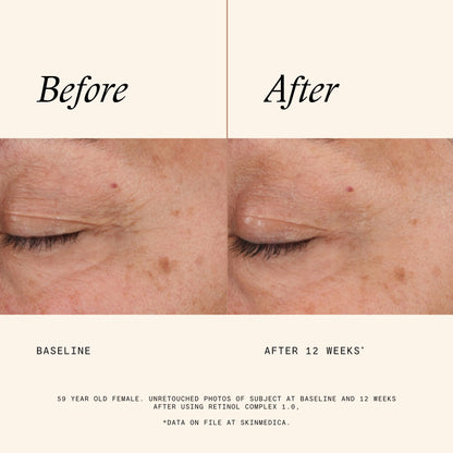 SkinMedica Retinol Serum 1.0 Complex - Serum for Face, Age-Defying Advanced Retinol Cream That Renews Skin and Diminishes