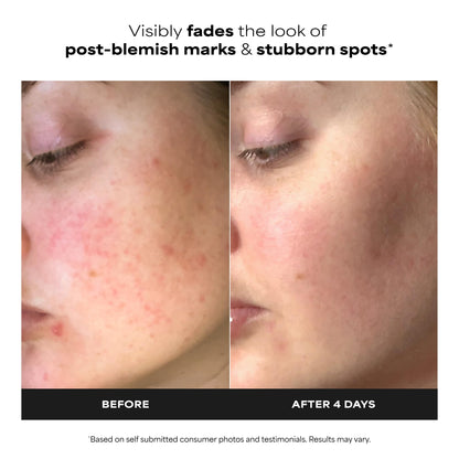 Paula’s Choice BOOST 10% Azelaic Acid Booster Cream Gel, Oil-Free Serum Fades Discoloration & Post-Blemish Marks, with Licorice Extract