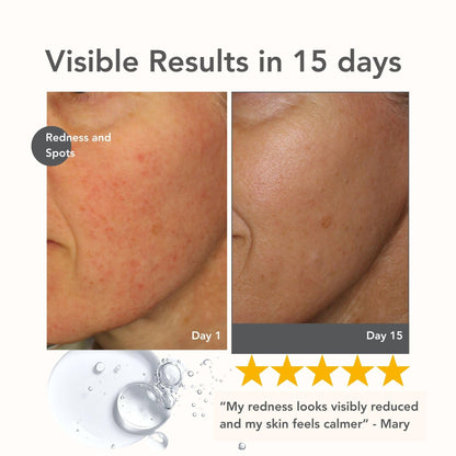 Riversol Rosacea Treatment for Face | Anti-Redness Serum for Sensitive Skin | Calming Redness Relief | Vitamin C & E | Anti-Aging Formula | Fragrance Free