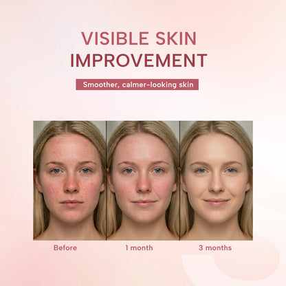 suquato 10% Azelaic Acid Cream – Rosacea Treatment for Face & Redness Reducing Face Cream – Redness & Blemish Care for Sensitive Skin