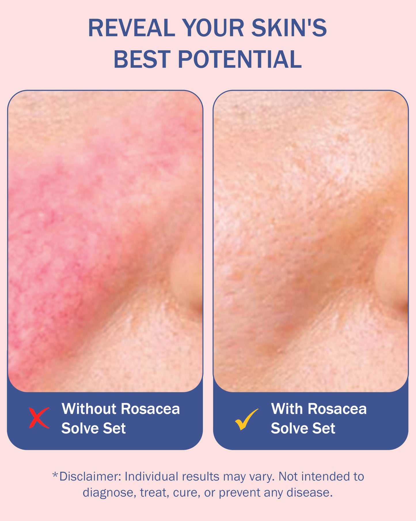 Rosacea Treatment Skincare for Women & Men - Face Wash, Rosacea Cream & Face Serum, Moisturizer Redness Reducing Skin Care with Aloe Vera,