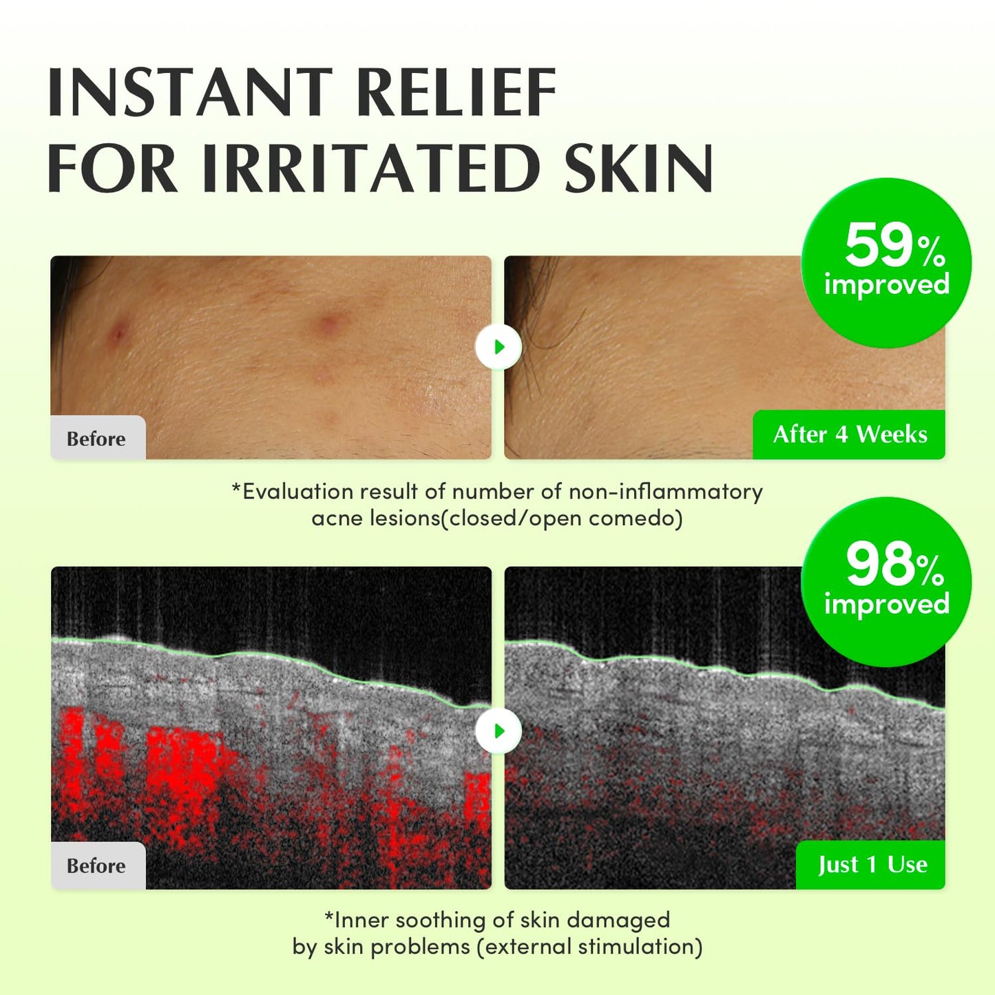 EQQUALBERRY Aloe PDRN Calming Toner, for Sensitive, | Instant Relief & Cooling | Non-Comedogenic & Fungal Acne Safe, Skin Barrier Repair