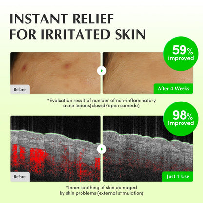 EQQUALBERRY Aloe PDRN Calming Toner, for Sensitive, | Instant Relief & Cooling | Non-Comedogenic & Fungal Acne Safe, Skin Barrier Repair