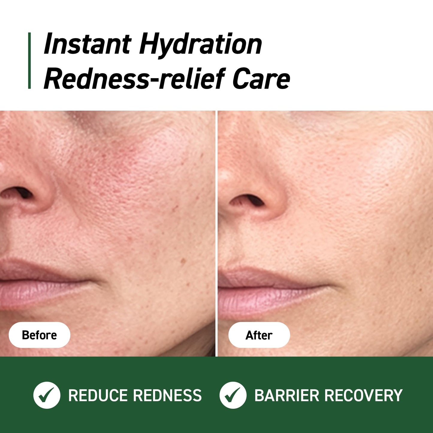IVOSKIN Cica Redness Relief Treatment Cream, Soothing & Hydrating Green Correcting Moisturizer with Madecassoside, Helps Repair Skin Barrier for Sensitive Skin