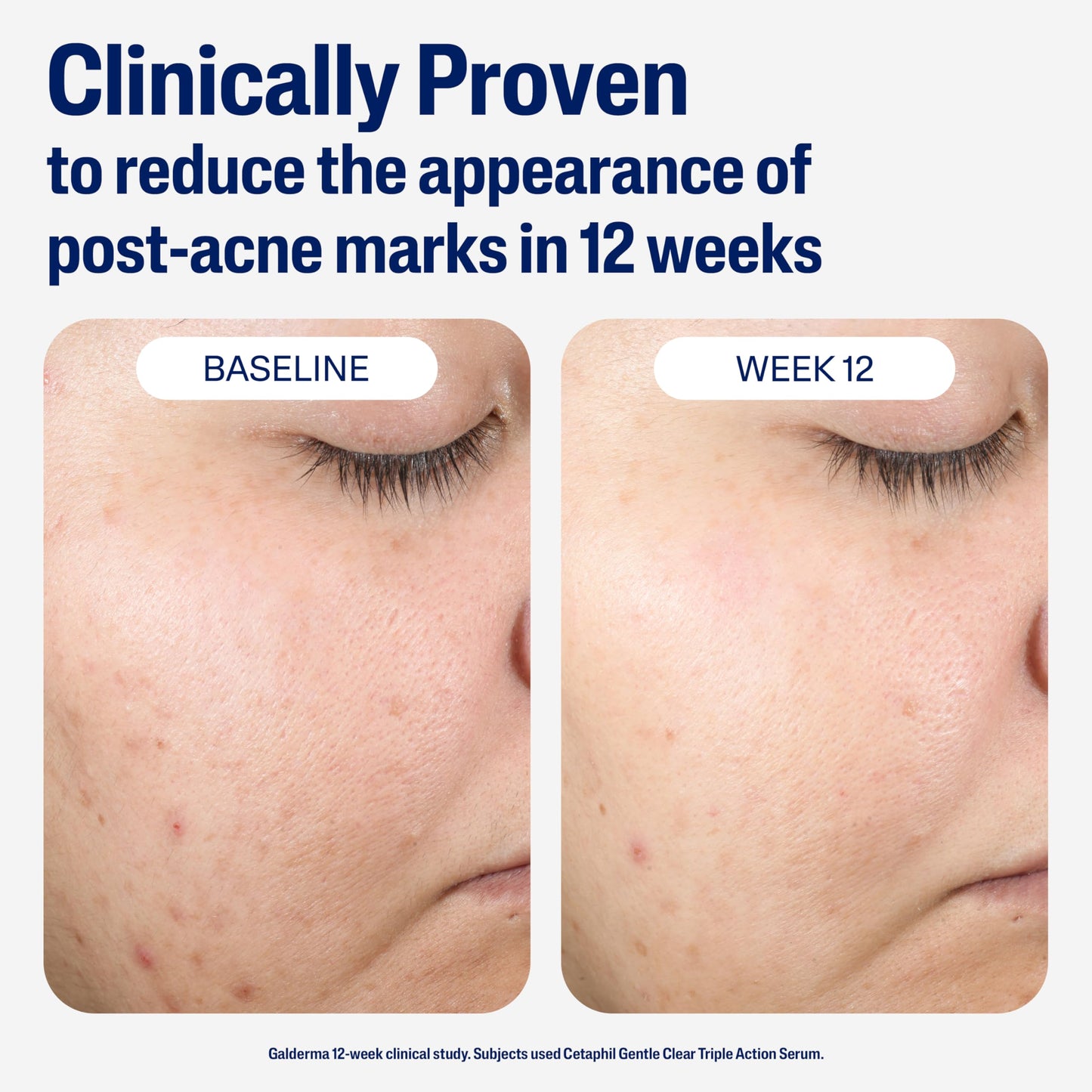 CETAPHIL Gentle Clear Repairing Post-Acne Serum, Retinol Alternative, Oil Free Serum for Sensitive Skin, 1 Fl Oz, Bakuchiol, Improves Skin Tone & Post-acne Marks,