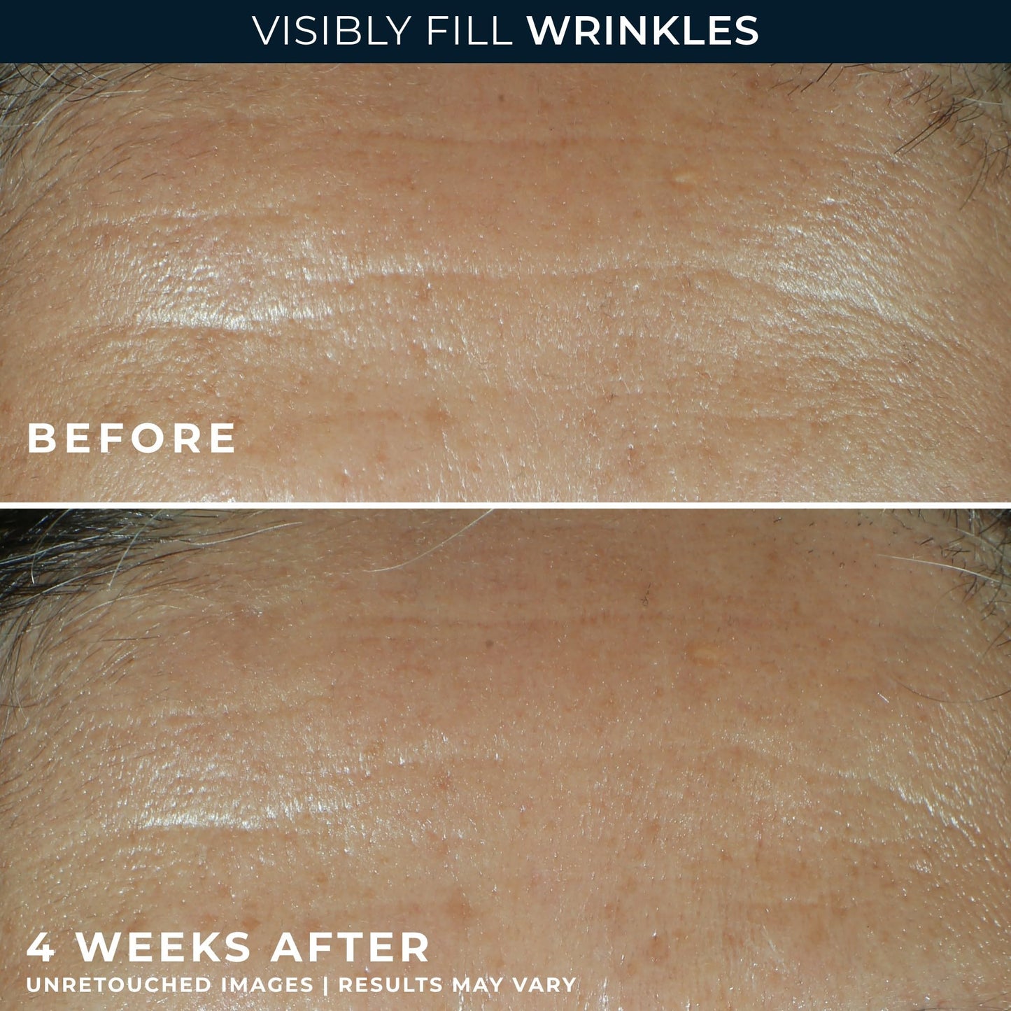 RoC Retinol Correxion Wrinkle Filler for Deep Wrinkles with Hyaluronic Acid & Retinol, Skin Care for Women and Men,
