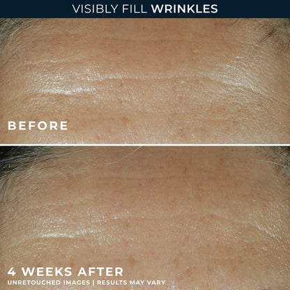 RoC Retinol Correxion Wrinkle Filler for Deep Wrinkles with Hyaluronic Acid & Retinol, Skin Care for Women and Men,