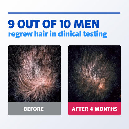Men’s Rogaine 5% Minoxidil for Men Foam, Clinically Proven Regrowth for Thinning Hair, Topical Hair Loss Treatment, Unscented Topical Aerosol, Results in 8–16 Weeks