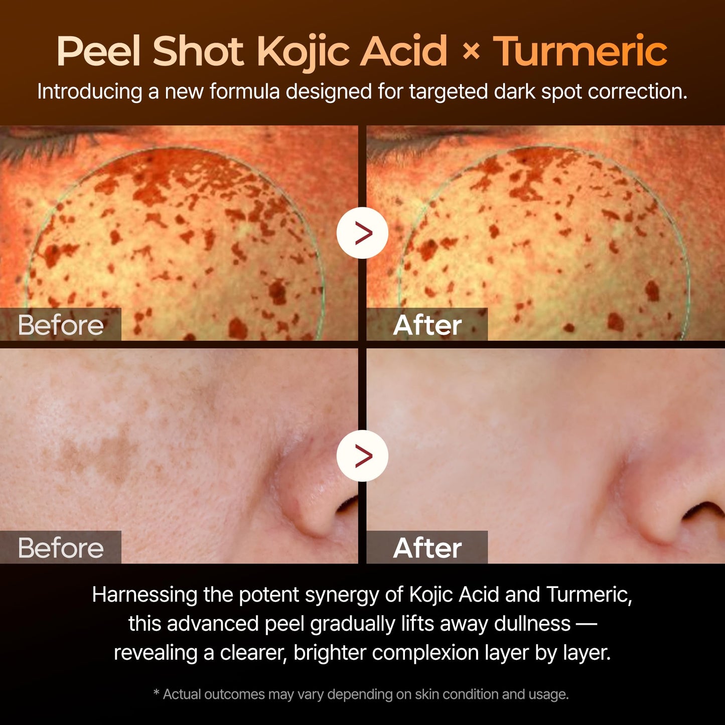Dr. Melaxin Peel Shot Kojic Acid Turmeric Serum – Exfoliating Dark Spot Corrector with AHA/BHA & Niacinamide, Brightening & Even Tone