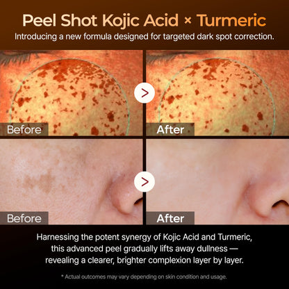 Dr. Melaxin Peel Shot Kojic Acid Turmeric Serum – Exfoliating Dark Spot Corrector with AHA/BHA & Niacinamide, Brightening & Even Tone