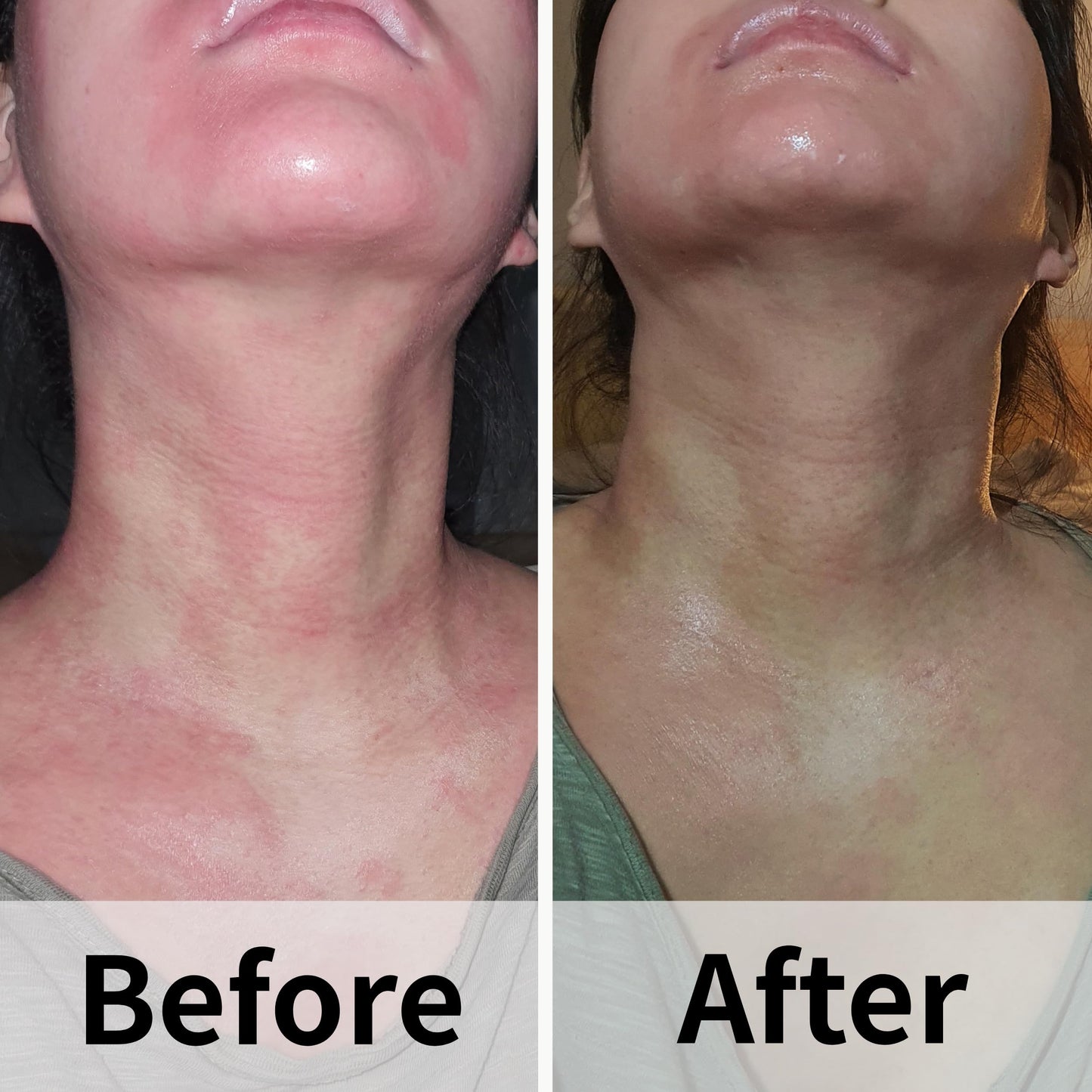 AD SOLUTION Ato Fast Calming Serum for Sensitive & Eczema-Prone Skin Instant Relief from Itch, Redness & Flare-Ups