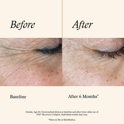SkinMedica TNS Recovery Complex Facial Treatment - Advanced Growth Factor & Exosome Formula for Skin Rejuvenation - Helps to Improve the Appearance of Fine Lines